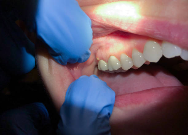 Best Emergency Dental Extractions in Beecher, IL